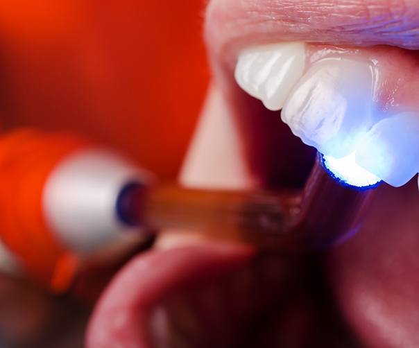 Tooth being treated with dental bonding