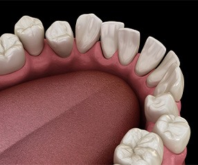 Illustration of gapped teeth