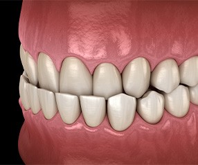 Illustration of underbite